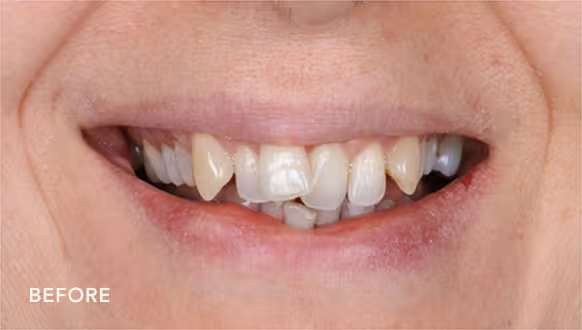 smile before